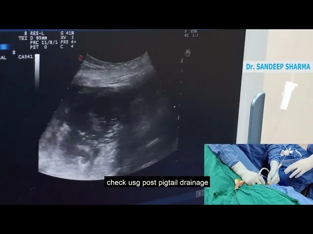 Psoas abscess drainage